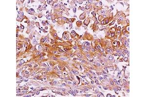 IHC testing of melanoma tissue stained with Melanoma antibody (NKI-beteb). (Melanoma Antikörper)