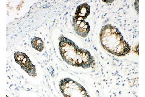 Anti-HYAL1 antibody,  IHC(P) IHC(P): Human Intestinal Cancer Tissue (HYAL1 Antikörper  (N-Term))