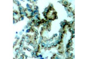Immunohistochemistry of paraffin-embedded human lung carcinoma tissue, using Phospho-PKCalpha/beta II-T638/641 antibody (ABIN3019760, ABIN3019761, ABIN3019762, ABIN1681948 and ABIN1681949). (PRKCA/PRKCB (pThr638), (pThr641) Antikörper)