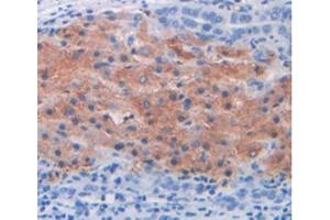 IHC-P analysis of Human Liver Cancer Tissue, with DAB staining. (MUC2 Antikörper  (AA 5075-5179))