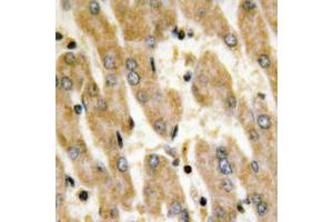 Immunohistochemical analysis of Fibronectin staining in human liver cancer formalin fixed paraffin embedded tissue section. (Fibronectin Antikörper  (C-Term))