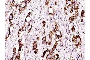 Paraformaldehyde-fixed, paraffin embedded human gastric cancer, Antigen retrieval by boiling in sodium citrate buffer (pH6) for 15min, Block endogenous peroxidase by 3% hydrogen peroxide for 30 minutes,  Blocking buffer (normal goat serum) at 37°C for 20min, Antibody incubation with ADAM17 (Thr735) Polyclonal Antibody (bs-12477R) at 1:400 overnight at 4°C, followed by a conjugated secondary and DAB staining. (ADAM17 Antikörper  (pThr735))