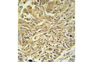 Immunohistochemistry analysis in formalin fixed and paraffin embedded lung carcinoma reacted with GSTK1 Antibody (Center) followed by peroxidase conjugation of the secondary antibody and DAB staining.