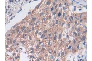 Detection of UTRN in Human Lung cancer Tissue using Polyclonal Antibody to Utrophin (UTRN) (Utrophin Antikörper  (AA 1-252))