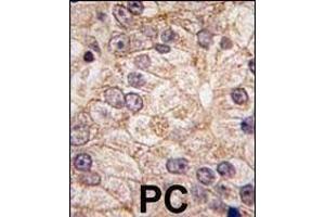 Formalin-fixed and paraffin-embedded human prostata carcinoma tissue reacted with PI4K II beta antibody (N-term), which was peroxidase-conjugated to the secondary antibody, followed by DAB staining.