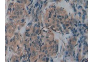 DAB staining on IHC-P; Samples: Human Breast cancer Tissue (Transferrin Receptor 2 Antikörper  (AA 211-405))