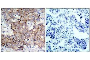 Immunohistochemical analysis of paraffin-embedded human breast carcinoma tissue, using HER2 (phospho- Tyr877) antibody (E011075). (ErbB2/Her2 Antikörper  (pTyr877))