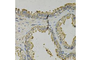 Immunohistochemistry of paraffin-embedded human prostate using FABP1 Antibody (ABIN5973056) at dilution of 1/100 (40x lens). (FABP1 Antikörper)