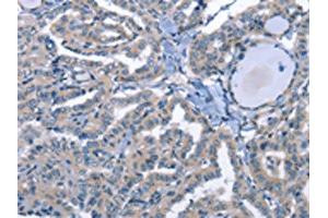 The image on the left is immunohistochemistry of paraffin-embedded Human thyroid cancer tissue using (LRRK2 Antibody) at dilution 1/30, on the right is treated with fusion protein. (LRRK2 Antikörper)