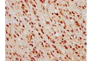 IHC image of ABIN7172910 diluted at 1:500 and staining in paraffin-embedded human glioma performed on a Leica BondTM system. (TSNAX Antikörper  (AA 1-87))