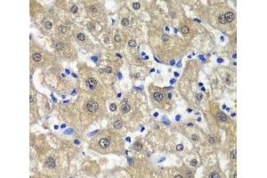 Immunohistochemistry of paraffin-embedded Human liver damage using MAT1A Polyclonal Antibody at dilution of 1:100 (40x lens). (MAT1A Antikörper)