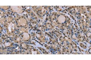 Immunohistochemistry of paraffin-embedded Human thyroid cancer tissue using DYNLL1 Polyclonal Antibody at dilution 1:30