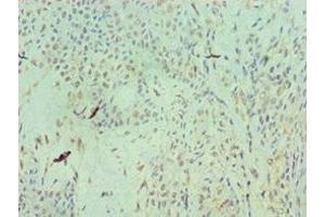 Immunohistochemistry of paraffin-embedded human breast cancer using ABIN7154577 at dilution of 1:100 (RAN Antikörper  (AA 1-216))