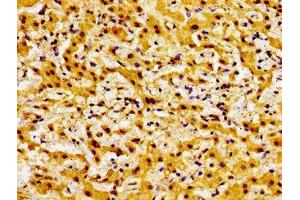 Immunohistochemistry of paraffin-embedded human liver cancer using ABIN7145314 at dilution of 1:100 (BOK Antikörper  (AA 15-103))