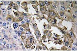 Immunohistochemistry (IHC) analyzes of RAGE antibody in paraffin-embedded human lung carcinoma tissue. (RAGE Antikörper)