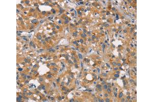 Immunohistochemistry (IHC) image for anti-Carcinoembryonic Antigen-Related Cell Adhesion Molecule 6 (CEACAM6) antibody (ABIN2426691)