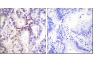 Immunohistochemistry analysis of paraffin-embedded human lung carcinoma tissue, using p15 INK Antibody. (CDKN2B Antikörper  (AA 89-138))