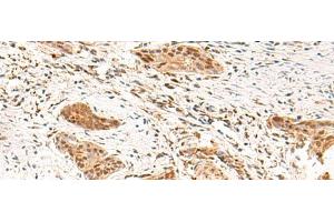 Immunohistochemistry of paraffin-embedded Human esophagus cancer tissue using TEAD3 Polyclonal Antibody at dilution of 1:50(x200) (TEAD3 Antikörper)