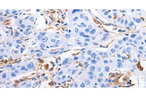Immunohistochemistry of paraffin-embedded Human lung cancer tissue using MFN1 Polyclonal Antibody at dilution 1:60 (MFN1 Antikörper)