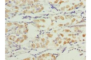 Immunohistochemistry of paraffin-embedded human gastric cancer using ABIN7171717 at dilution of 1:100 (SMG6 Antikörper  (AA 251-511))