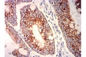 Immunohistochemical analysis of paraffin-embedded rectum cancer tissues using PLA2G7 mouse mAb with DAB staining. (PLA2G7 Antikörper  (AA 22-441))
