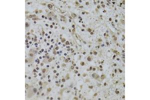 Immunohistochemistry of paraffin-embedded human liver cancer using INTS6 Antibody.