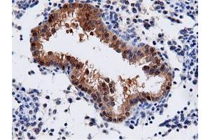 Immunohistochemical staining of paraffin-embedded Adenocarcinoma of Human endometrium tissue using anti-AK5 mouse monoclonal antibody. (Adenylate Kinase 5 Antikörper)