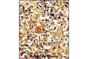 Formalin-fixed and paraffin-embedded human breast carcinoma with PTAR1 Antibody (Center), which was peroxidase-conjugated to the secondary antibody, followed by DAB staining. (PTAR1 Antikörper  (AA 60-89))