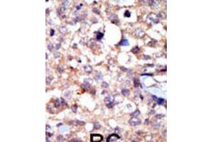 Formalin-fixed and paraffin-embedded human cancer tissue reacted with the primary antibody, which was peroxidase-conjugated to the secondary antibody, followed by AEC staining. (ABL1 Antikörper  (C-Term))