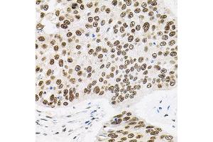 Immunohistochemistry of paraffin-embedded human lung cancer using BAF60a antibody. (SMARCD1 Antikörper)
