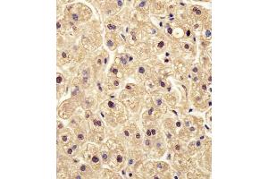 (ABIN6242566 and ABIN6578504) staining PGM1 in human liver tissue sections by Immunohistochemistry (IHC-P - paraformaldehyde-fixed, paraffin-embedded sections). (Phosphoglucomutase 1 Antikörper  (AA 251-282))