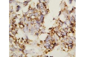 IHC-P: N-Cadherin antibody testing of human ovary cancer tissue (N-Cadherin Antikörper  (AA 701-714))