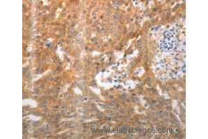 Immunohistochemistry of Human ovarian cancer using NQO1 Polyclonal Antibody at dilution of 1:25 (NQO1 Antikörper)