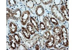 Immunohistochemical staining of paraffin-embedded Carcinoma of liver tissue using anti-LIPG mouse monoclonal antibody. (LIPG Antikörper)