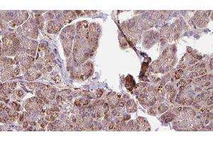 ABIN6273291 at 1/100 staining Human pancreas cancer tissue by IHC-P. (PDHB Antikörper  (N-Term))