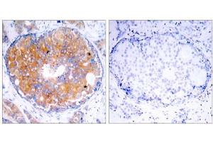 Immunohistochemical analysis of paraffin-embedded human breast carcinoma tissue using MEK2 (Ab-394) antibody (E021008). (MEK2 Antikörper)