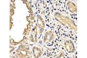 Immunohistochemistry of paraffin-embedded Human kidney cancer using ARRB2 Polyclonal Antibody at dilution of 1:200 (40x lens). (Arrestin 3 Antikörper)