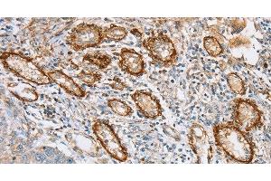 Immunohistochemistry of paraffin-embedded Human lung cancer tissue using CD108 Polyclonal Antibody at dilution 1:35 (SEMA7A Antikörper)