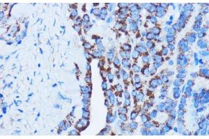Immunohistochemistry of paraffin-embedded Human thyroid cancer using DDIT3 / CHOP Polyclonal Antibody at dilution of 1:100 (40x lens). (DDIT3 Antikörper)