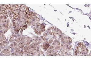 ABIN6273239 at 1/100 staining Human pancreas cancer tissue by IHC-P. (ETFDH Antikörper  (C-Term))