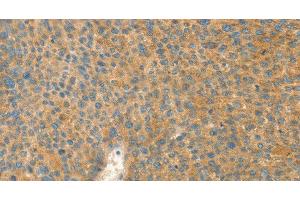 Immunohistochemistry of paraffin-embedded Human liver cancer tissue using AANAT Polyclonal Antibody at dilution 1:40 (AANAT Antikörper)