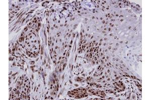 IHC-P Image Immunohistochemical analysis of paraffin-embedded Cal27 xenograft, using CTDP1 , antibody at 1:100 dilution. (CTDP1 Antikörper  (N-Term))