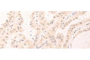 Immunohistochemistry of paraffin-embedded Human thyroid cancer tissue using IL7 Polyclonal Antibody at dilution of 1:30(x200) (IL-7 Antikörper)