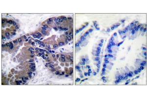 Immunohistochemical analysis of paraffin-embedded human lung carcinoma tissue, using NFE2L2 antibody (ABIN5976469). (NRF2 Antikörper  (C-Term))