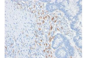 Formalin-fixed, paraffin-embedded human Colon Carcinoma stained with CD209 Mouse Monoclonal Antibody (C209/1781). (DC-SIGN/CD209 Antikörper)