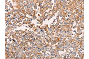 The image on the left is immunohistochemistry of paraffin-embedded Human breast cancer tissue using ABIN7129618(GNA11 Antibody) at dilution 1/40, on the right is treated with fusion protein.