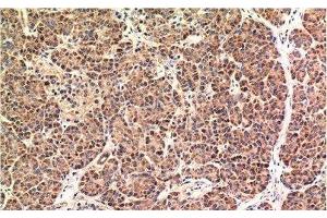 Immunohistochemistry of paraffin-embedded Human pancreas carcinoma tissue using CHOP Monoclonal Antibody at dilution of 1:200. (DDIT3 Antikörper)