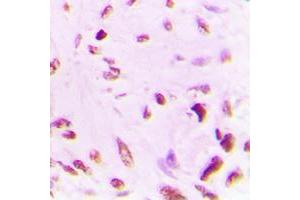 Immunohistochemical analysis of p53 (AcK381) staining in human lung cancer formalin fixed paraffin embedded tissue section. (p53 Antikörper  (acLys381, C-Term))