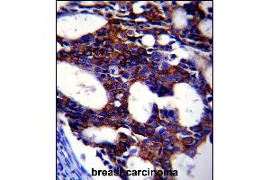 TGFB2 Antibody (ABIN659106 and ABIN2838086) immunohistochemistry analysis in formalin fixed and paraffin embedded human breast carcinoma followed by peroxidase conjμgation of the secondary antibody and DAB staining. (TGFB2 Antikörper)