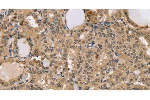 Immunohistochemistry of paraffin-embedded Human thyroid cancer using CENPV Polyclonal Antibody at dilution of 1:40 (CENPV Antikörper)